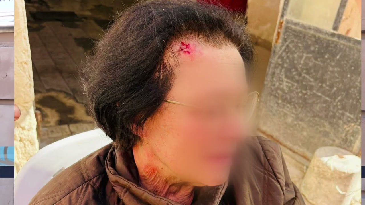 Cade Su Marciapiedi Rotto Dell’ex Manifattura E Si Frattura Il Braccio, Bratta: “ennesimo Episodio” – Video